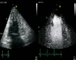 Miocardiopatía