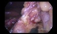 Gastrectomía proximal de doble vía laparoscópica