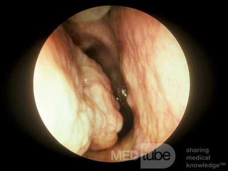 Extremo posterior agrandado de un cornete inferior derecho