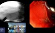 Abordaje del borde pilórico mediante CPRE para la estenosis de la anastomosis coledocoduodenal.