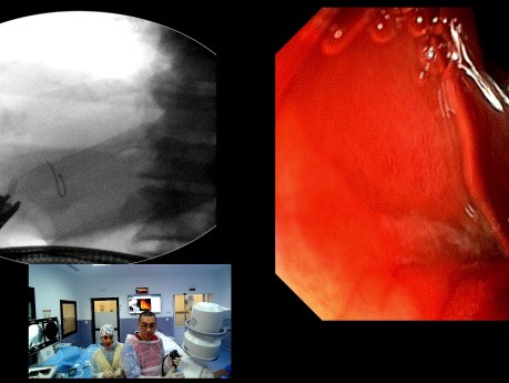 Abordaje del borde pilórico mediante CPRE para la estenosis de la anastomosis coledocoduodenal.