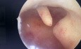 Pólipo endometrial por histeroscopia 