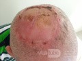 Angiosarcoma del cuero cabelludo - escisión y colgajo de piel libre extraido de ambos brazos internos