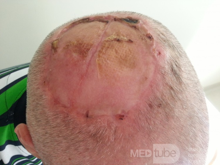 Angiosarcoma del cuero cabelludo - escisión y colgajo de piel libre extraido de ambos brazos internos