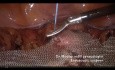 Pectopexia laparoscópica para el prolapso genitourinario