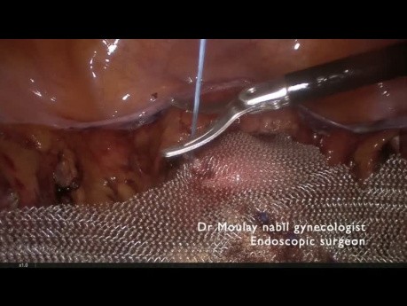 Pectopexia laparoscópica para el prolapso genitourinario