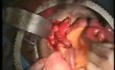 Enganche del psoas y colgajo de Boari para reemplazo completo del uréter