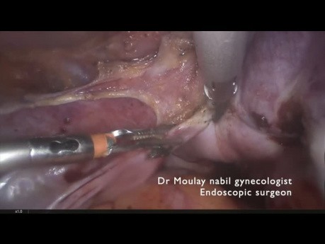 Histerectomía en útero muy grande (más de 1000 gramos)