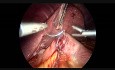 Derivación biliopancreática en dos pasos con cruce duodenal cosido a mano