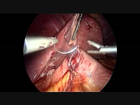 Derivación biliopancreática en dos pasos con cruce duodenal cosido a mano