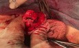 Cancer de pene. Glandectomía submucosa total y reconstrucción con injerto cutáneo de piel del muslo
