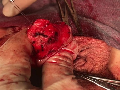 Cancer de pene. Glandectomía submucosa total y reconstrucción con injerto cutáneo de piel del muslo