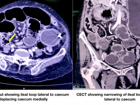 Cirugía laparoscópica de una hernia retrocecal, causa de obstrucción aguda del intestino delgado