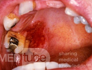 Eritroplasia [carcinoma in situ]