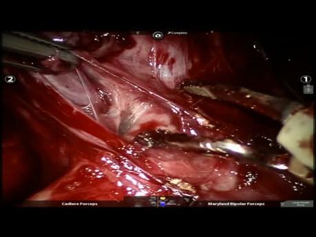 Lesión pulmonar quística