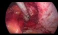 Reparación laparoscópica de la hernia paraestomal mediante la técnica de Sugarbacker modificada
