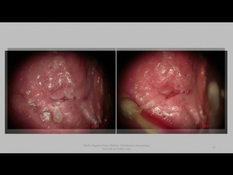 Vulva 22 Anos Vin 2 Condilomas Tratamiento