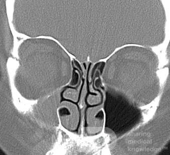 Hipoplasia del seno maxilar [tipo 2]