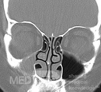 Hipoplasia del seno maxilar [tipo 2]