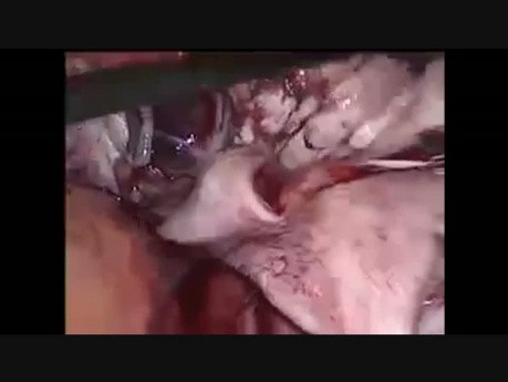 Extracción laparoscópica de un quiste de chocolate con preservación del ovario