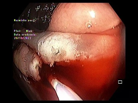 Resección endoscópica de la mucosa (REM) y disección endoscópica submucosa (ESD) en colon ascendente