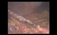 Infarto omental idiopático