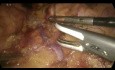 Adrenalectomía izquierda: abordaje laparoscópico