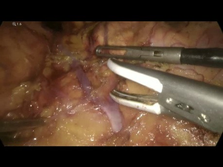 Adrenalectomía izquierda: abordaje laparoscópico