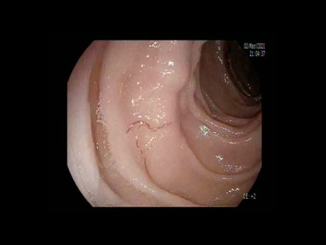 Anquilostoma: enganchado y causante de hemorragia gastrointestinal