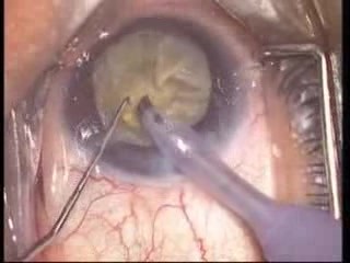 Cirugía de Cataratas - Facoemulsificación