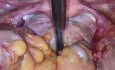 Reseccion Anterior Ultrabaja Por Nm De Recto