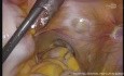 Proctectomia total laparoscopica mas anastomosis coloanal sin ileostomia de proteccion