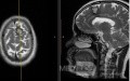 Estirpación de cavernoma subcortical 