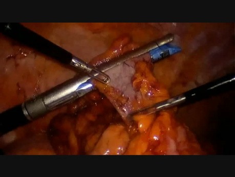 Mini hemicolectomía derecha laparoscópica asistida por vía transvaginal 