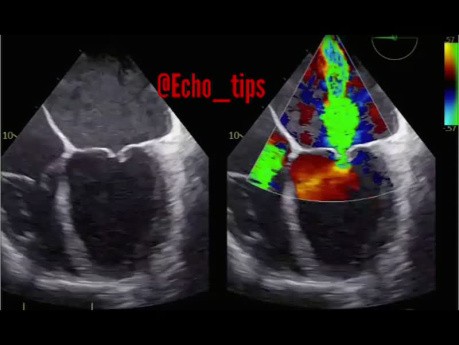 Visualización por ETE de insuficiencia valvular mitral grave: valvas mal coaptadas y jet central