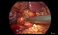 Coledocotomía laparoscópica y drenaje de absceso hepático