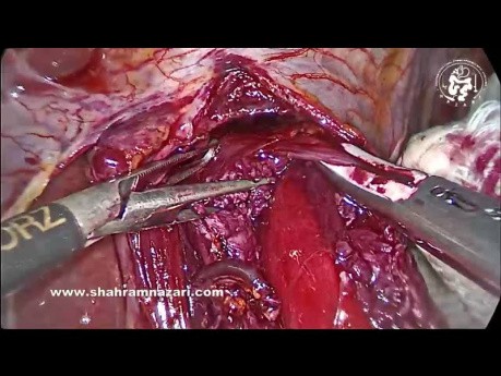 Technique of Heller Myotomy for Achalasia