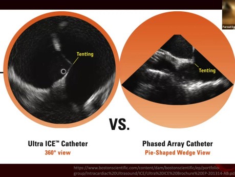 Introducción a la ecocardiografía intracardíaca (ICE)