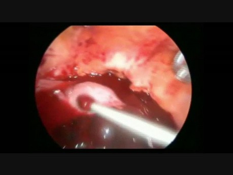 Salpingectomía laparoscópica por EP con hemoperitoneo