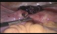 Embarazo ectópico - salpingostomia y fimbrioplastia 