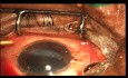 Eliminación de múltiples cuerpos extraños de un solo ojo con recuperación visual exitosa