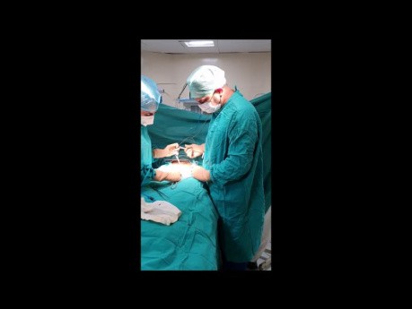 Lipoma de la ingle hernia de grasa preperitoneal - hernia de la ingle femenina