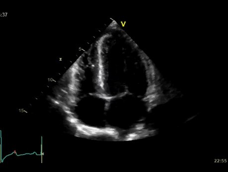 Hipertension arterial con afectación del musculo cardiaco