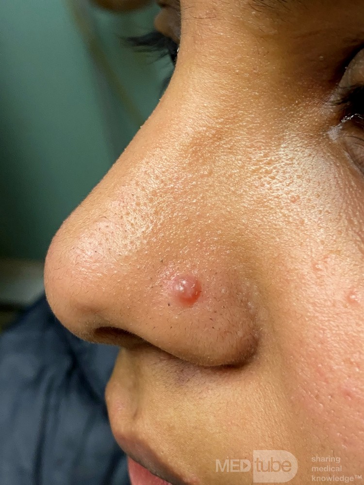 Cicatriz hipertrófica después de una perforación nasal