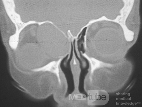 Mucocele etmoidal anterior con extensión intraorbitaria extensa [tomografía computarizada]