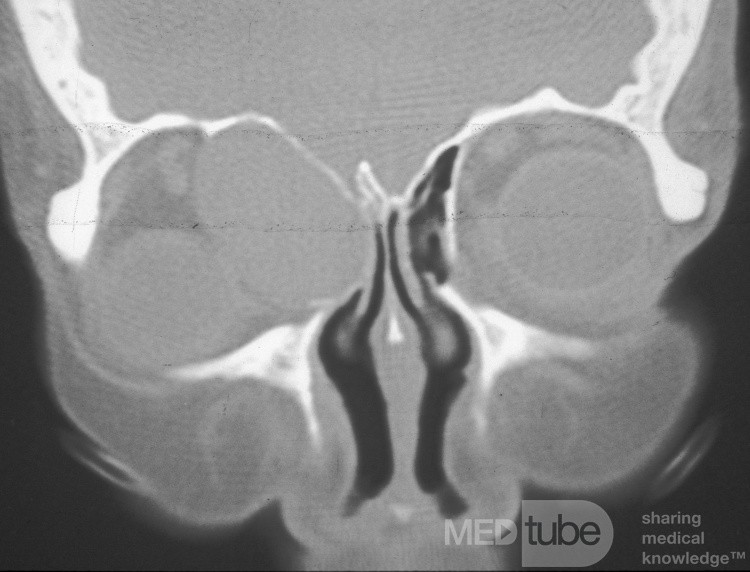 Mucocele etmoidal anterior con extensión intraorbitaria extensa [tomografía computarizada]