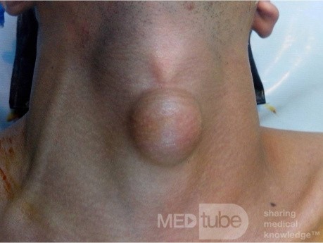 Lipoma de cuello de línea media