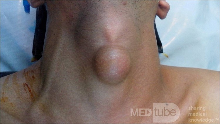 Lipoma de cuello de línea media