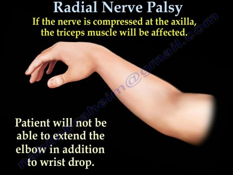 Parálisis del nervio radial - parálisis del sábado noche - Parte 1