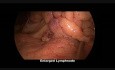 Hemicolectomía radical derecha laparoscópica para NET de íleon terminal